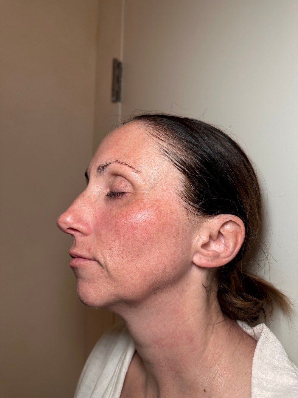 Face profile — after 2 XERF treatments — after