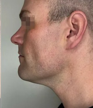 Jawline — after 2 XERF treatments — after