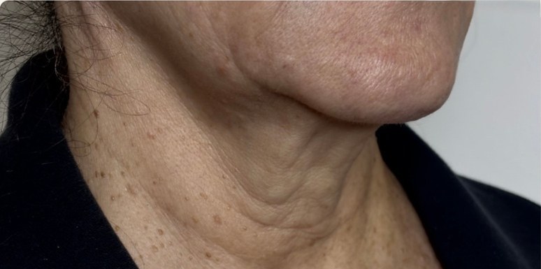 Neck — after 3 XERF treatments — before