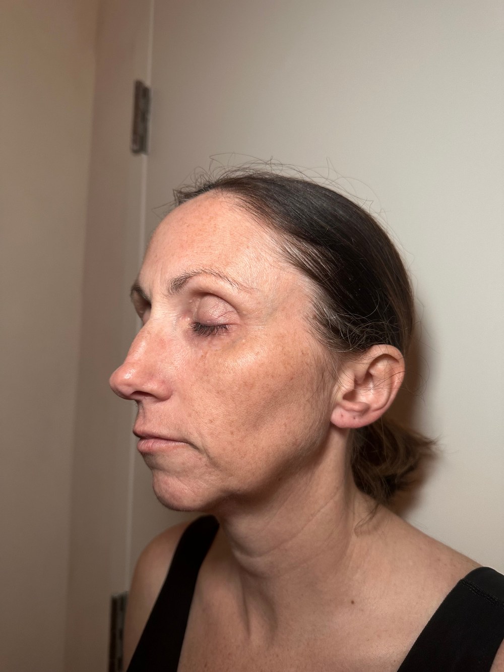 Face profile — after 2 XERF treatments — before