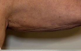 Arm — after 1 XERF treatment — before