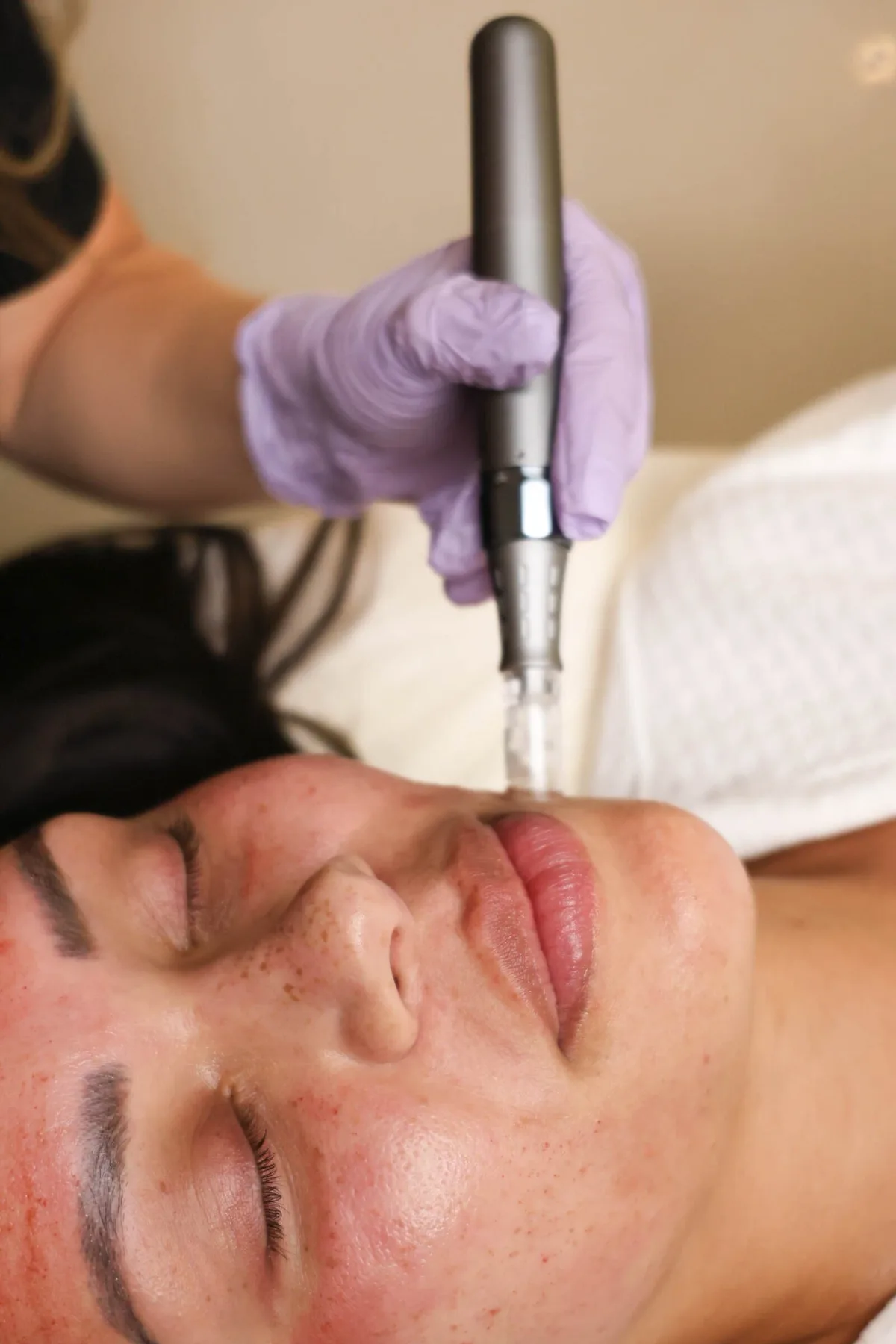 Skin renewal