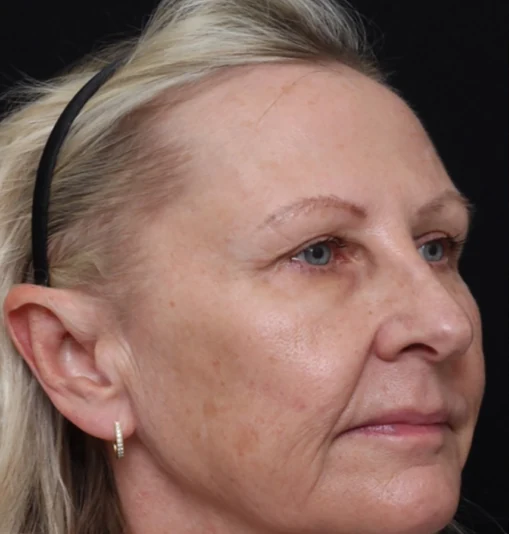 After 1 Ultra treatment — before
