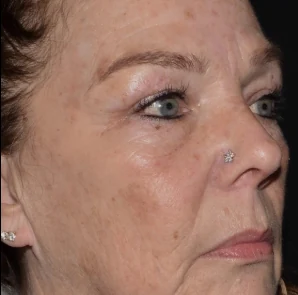 After 4 Ultra treatments — after