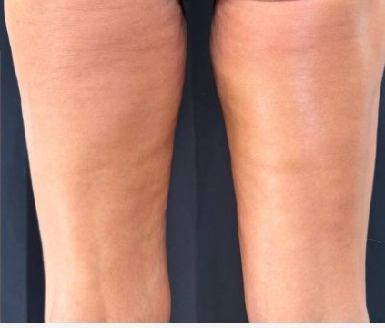 Thighs — one month after 2 XERF treatments — after