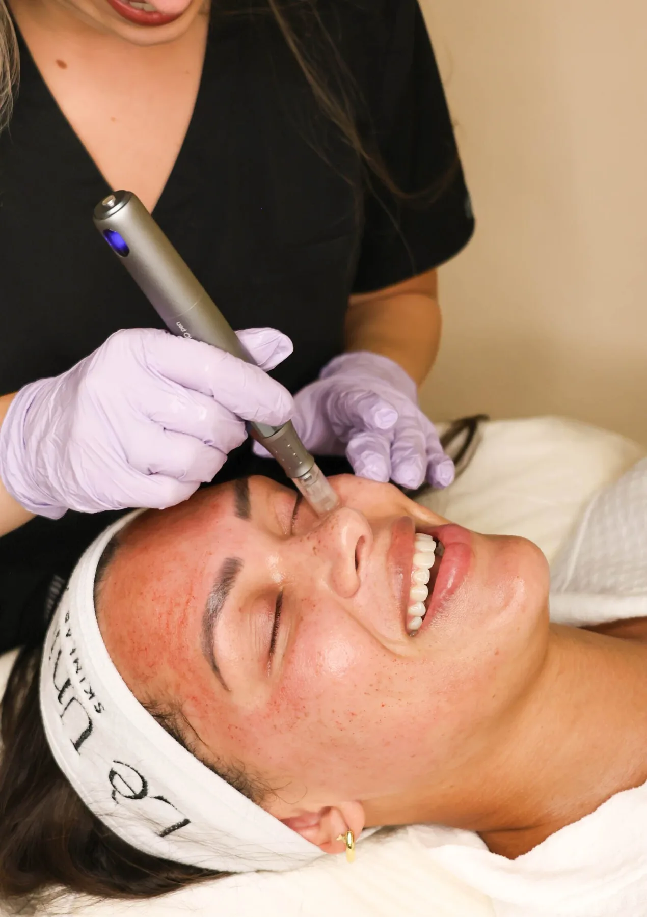 RF Microneedling