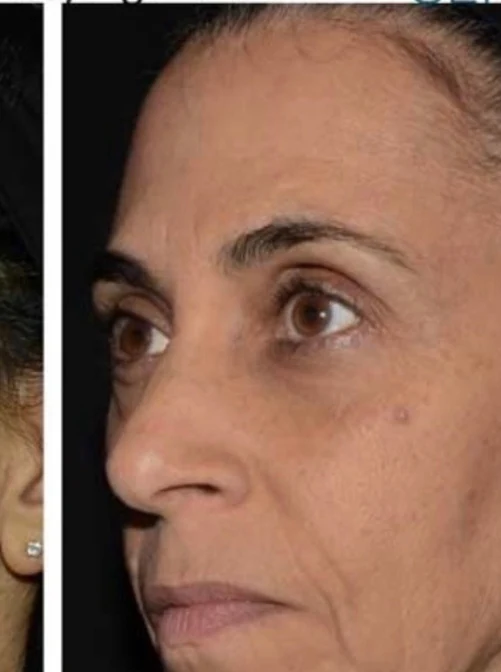 After 3 Ultra treatments — after