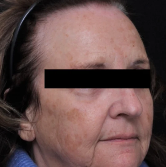 After 3 Ultra treatments — before