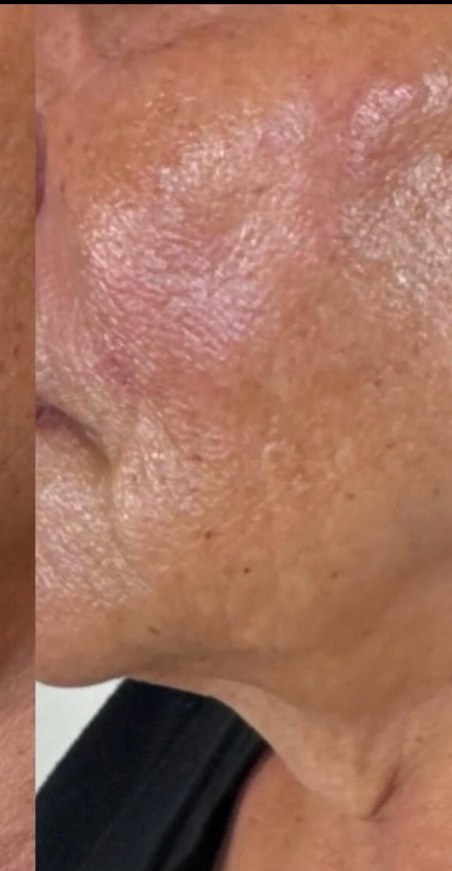 Jawline & lower face — after 4 XERF treatments — after