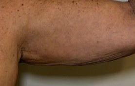 Arm — after 1 XERF treatment — after