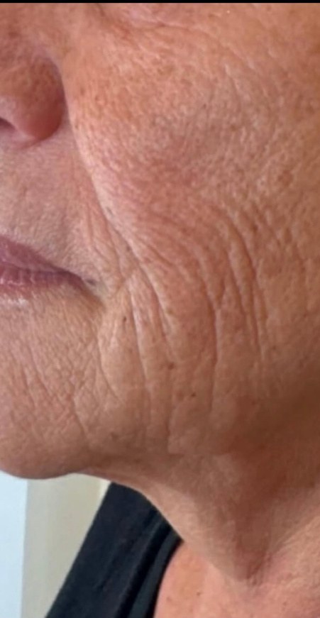 Jawline & lower face — after 4 XERF treatments — before