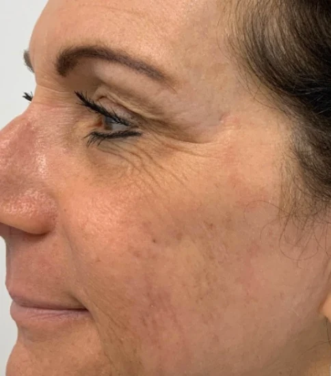 After 3 Ultra treatments — after