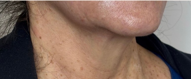 Neck — after 3 XERF treatments — after