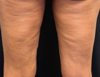 Thighs — one month after 2 XERF treatments — before